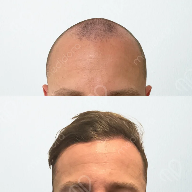 Haartransplantation Vorher Nachher