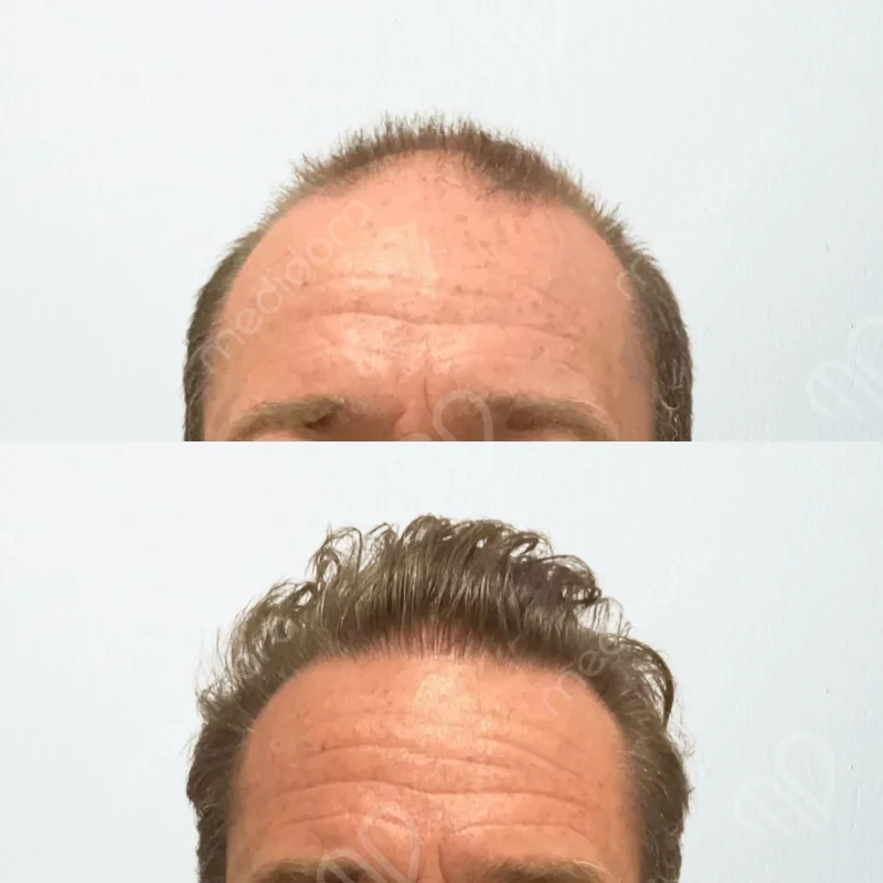 Haartransplantation Vorher Nachher