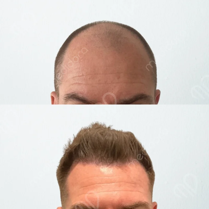 Haartransplantation Vorher Nachher