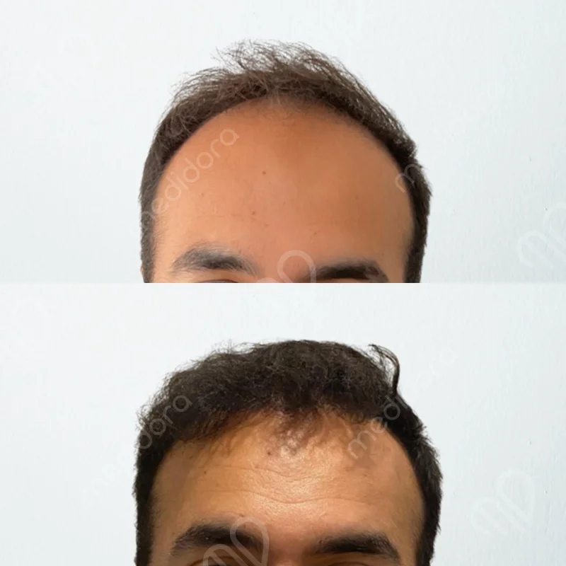 Haartransplantation Vorher Nachher