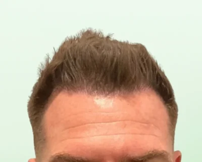 Hair Transplant After