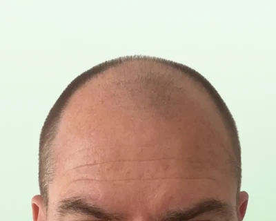 Hair Transplant Before