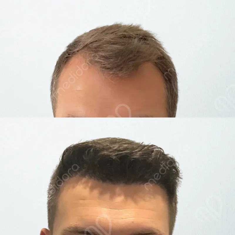 Hair Transplant Before After