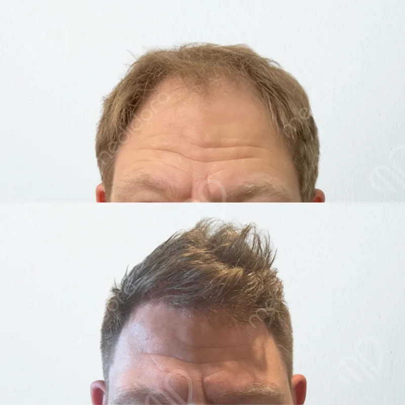 Hair Transplant Before After